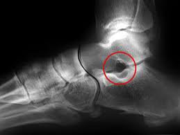 צילום רנטגן של הסינוס טארסאלי בכף הרגל